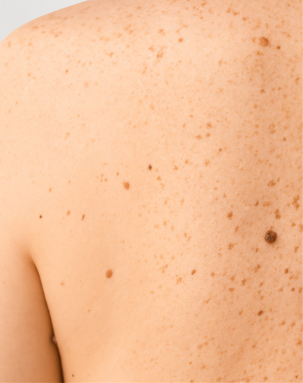 Skin cancer and skin lesions