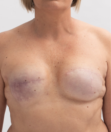 Autologous breast reconstruction